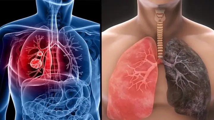 Nằm Mơ Thấy Mình Bị Ung Thư Sắp Chết