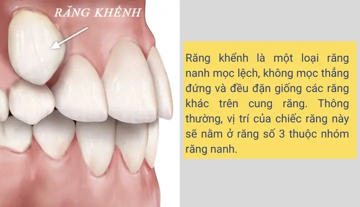 Nằm Mơ Thấy Mọc Răng Khểnh Đánh Con Gì