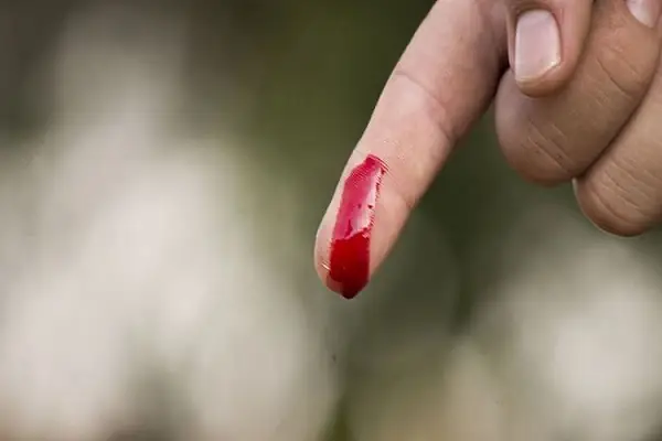 Nằm Mơ Thấy Người Thân Bị Đứt Tay Chảy Máu