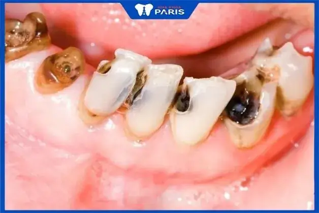 Nằm Mơ Thấy Nhổ Răng Đánh Số May