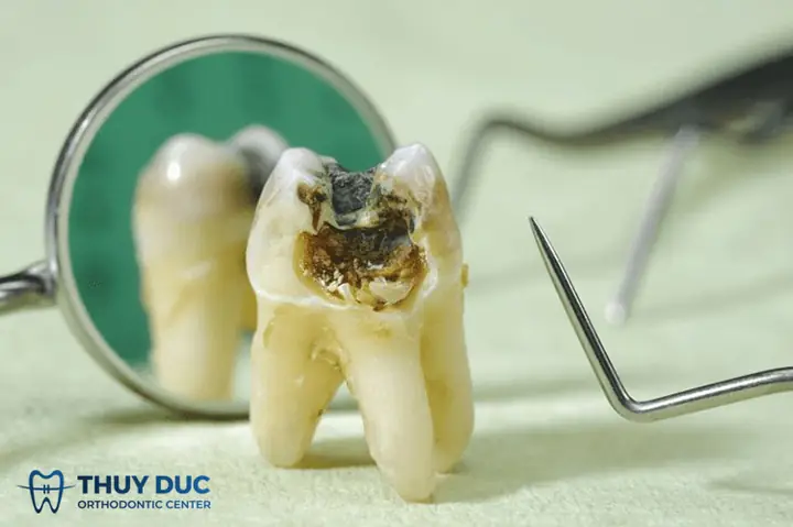 Nằm Mơ Thấy Răng Bị Bể Là Điềm Gì