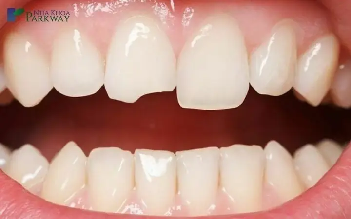 Nằm Mơ Thấy Răng Bị Bể Là Điềm Gì
