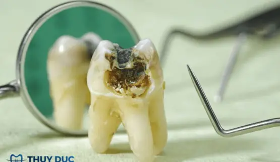 Nằm Mơ Thấy Răng Bị Bể Là Điềm Gì