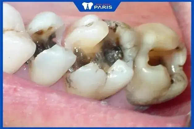 Nằm Mơ Thấy Răng Bị Sâu Đánh Số May Nằm Mơ Thấy Răng Bị Sâu Đánh Số May