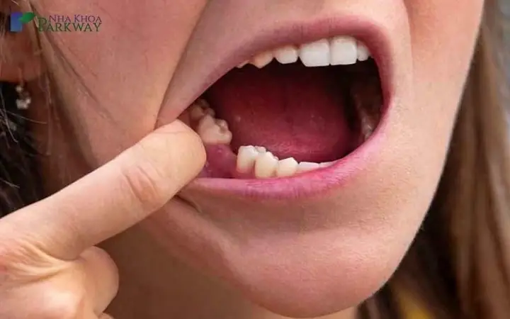 Nằm Mơ Thấy Rụng Hết 2 Hàm Răng