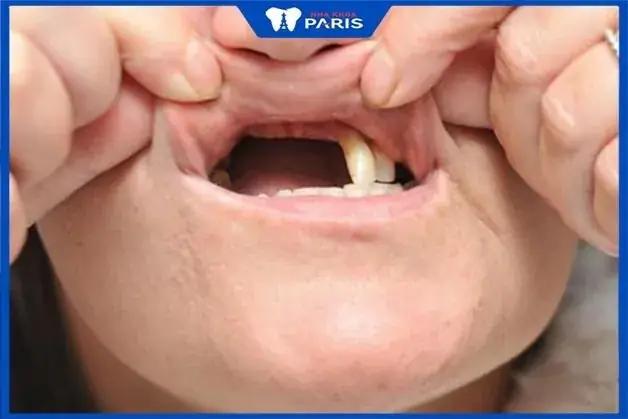 Nằm Mơ Thấy Rụng Răng Điềm Báo Gì