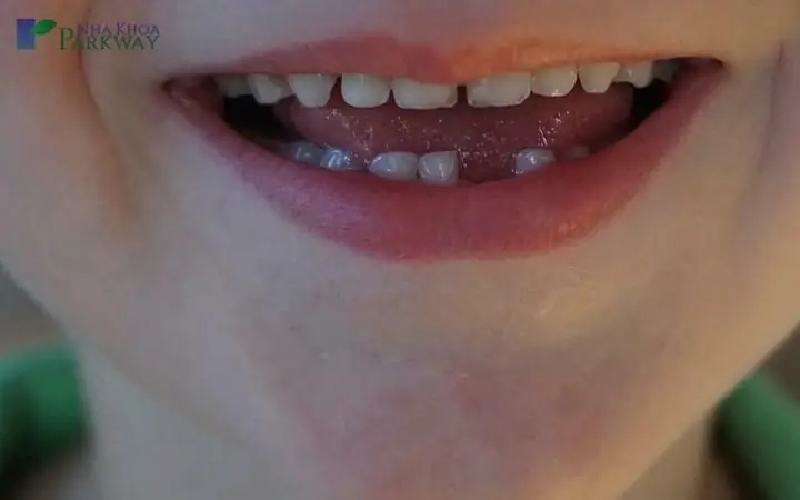 Nằm Mơ Thấy Rụng Răng Hàm Dưới Có Máu Nằm Mơ Thấy Rụng Răng Hàm Dưới Có Máu
