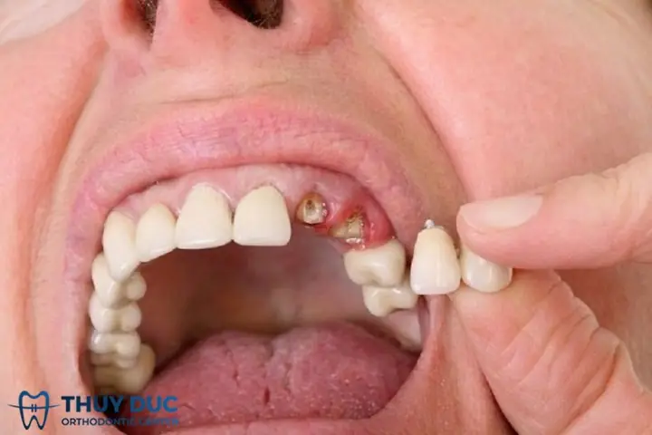 Nằm Mơ Thấy Rụng Răng Là Điềm Gì