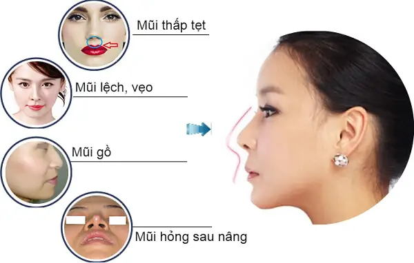 Nâng Mũi Có Bị Phá Tướng Không