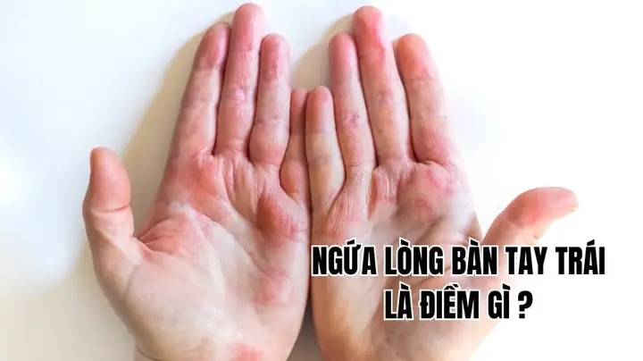 Ngứa Lòng Bàn Tay Trái Nam Là Điềm Gì Ngứa Lòng Bàn Tay Trái Nam Là Điềm Gì