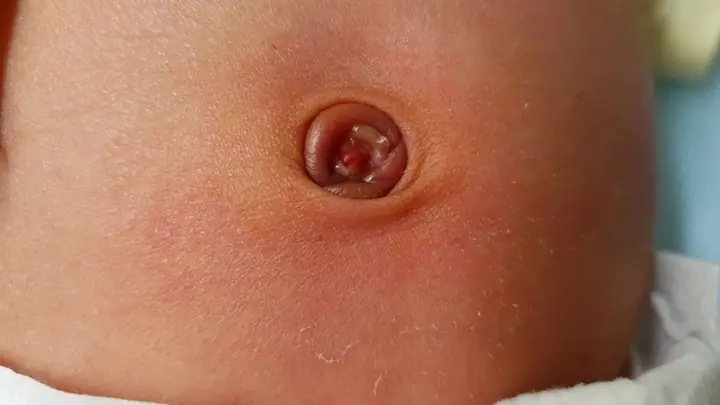 Ngứa Rốn Là Điềm Gì Ngứa Rốn Là Điềm Gì