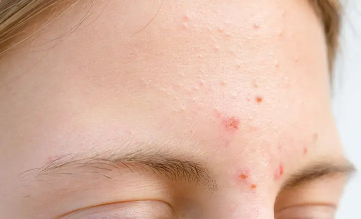 Ngứa Trán La Điềm Gì Ngứa Trán La Điềm Gì