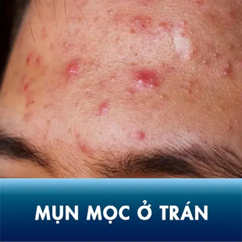 Ngứa Trán La Điềm Gì
