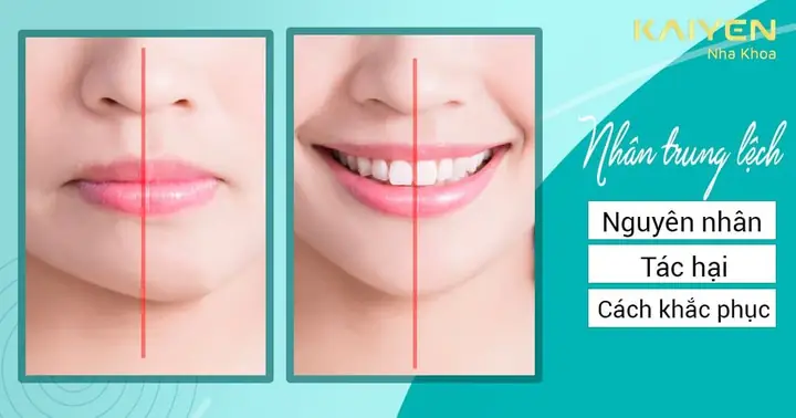 Nhân Trung Lệch Nhân Tướng Học