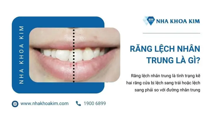 Nhân Trung Lệch Nhân Tướng Học