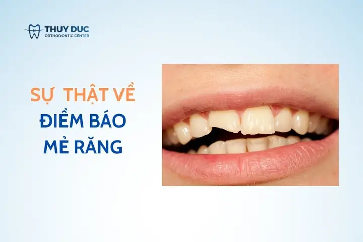 Nhức Nướu Răng Cùng Có Điềm Báo Gì K Nhức Nướu Răng Cùng Có Điềm Báo Gì K