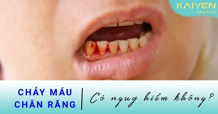 Nhức Nướu Răng Cùng Có Điềm Báo Gì K Nhức Nướu Răng Cùng Có Điềm Báo Gì K