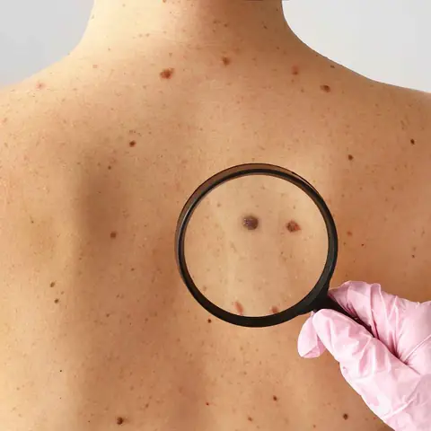 Nốt Ruồi Điềm Báo Nốt Ruồi Điềm Báo