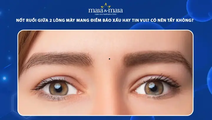 Nốt Ruồi Điềm Báo Nốt Ruồi Điềm Báo
