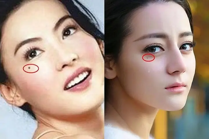 Nốt Ruồi Phá Tướng