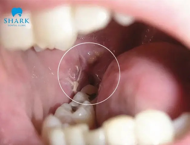 Răng Cắn Vào Má Trong Là Điềm Gì Răng Cắn Vào Má Trong Là Điềm Gì