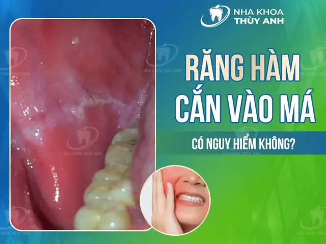 Răng Cắn Vào Má Trong Là Điềm Gì Răng Cắn Vào Má Trong Là Điềm Gì