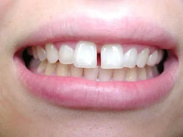 Răng Cửa Hàm Dưới Thưa Tướng Số