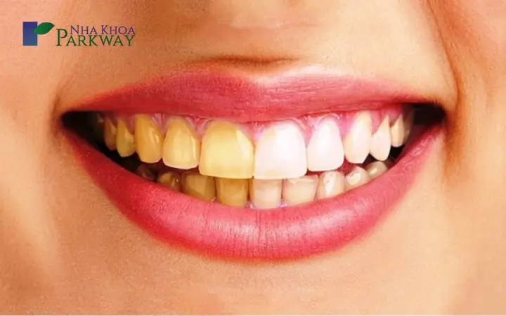 Răng Cửa Họ Trong Tướng Số Răng Cửa Họ Trong Tướng Số