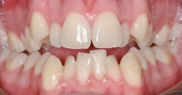 Răng Cụp Vào Trong Tướng Số