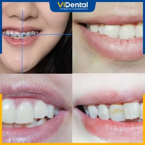 Răng Hàm Dưới Không Đều Nhân Tướng Học