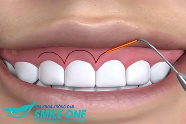 Răng Ngắn Cười Hở Lợi Tướng Số Răng Ngắn Cười Hở Lợi Tướng Số
