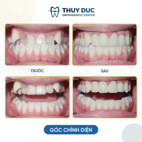 Răng Nhọn Tướng Số Răng Nhọn Tướng Số