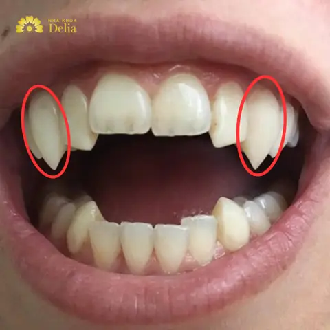 Răng Nhọn Tướng Số Răng Nhọn Tướng Số