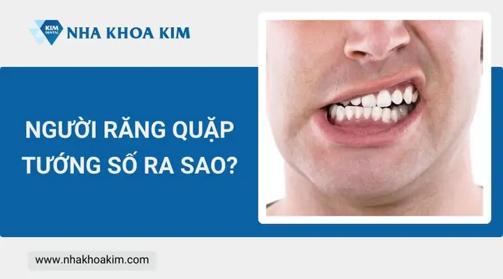 Răng Quặp Vào Trong Tướng Số