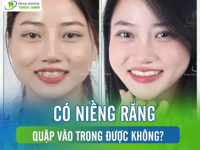 Răng Quặp Vào Trong Tướng Số