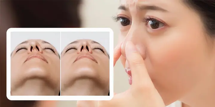 Sống Mũi Bị Lệch Tướng Số