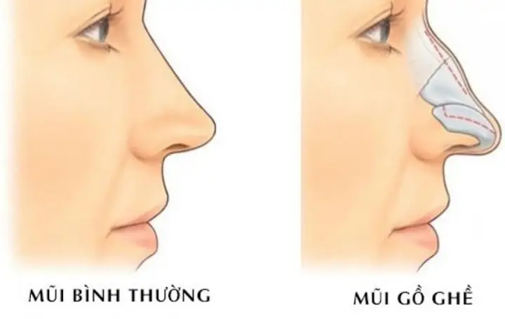 Sống Mũi Gồ Nhân Tướng Học