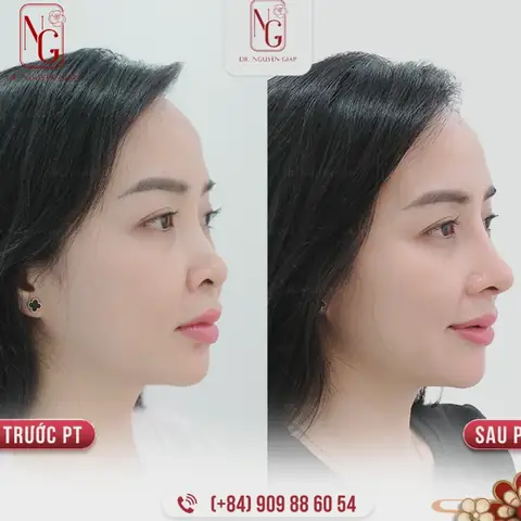 Sống Mũi Gồ Nhân Tướng Học Nam