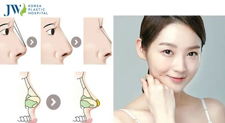 Sửa Mũi Có Phá Tướng Không