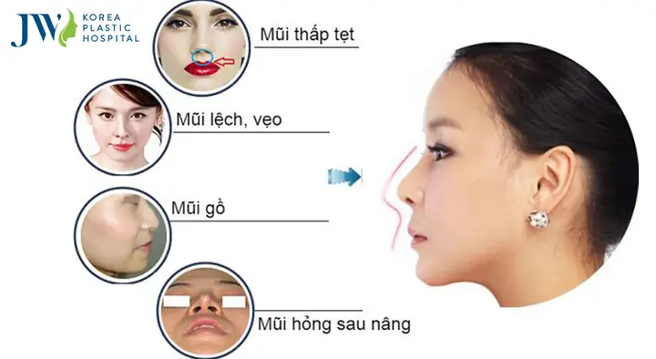 Sửa Mũi Có Phá Tướng Không
