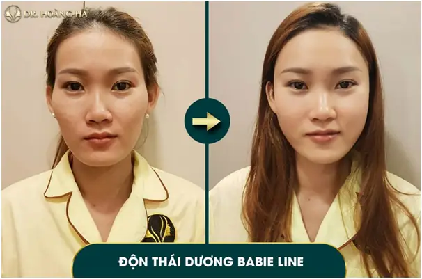 Thái Dương Lõm Gò Má Cao Tướng Số