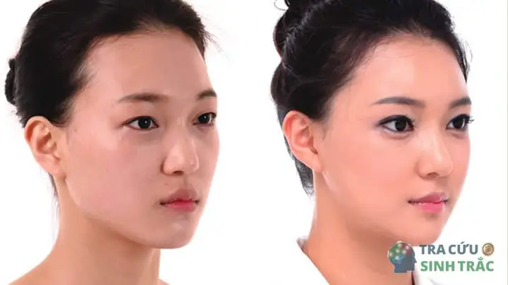 Thái Dương Lõm Gò Má Cao Tướng Số