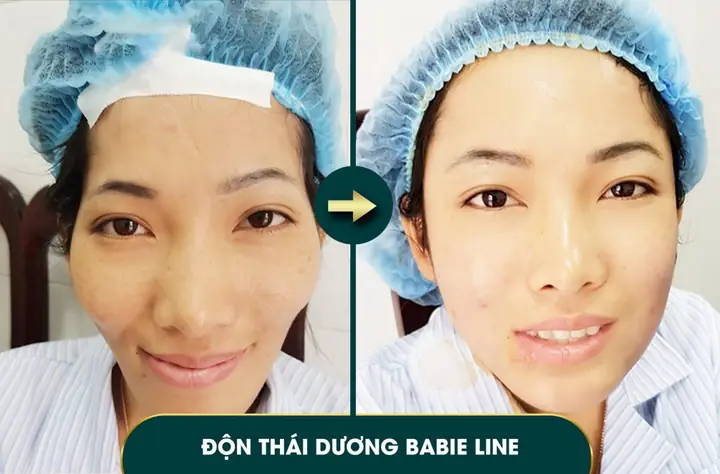 Thái Dương Lõm Gò Má Cao Tướng Số