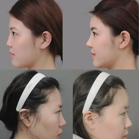 Trán Lõm Nhân Tướng Học