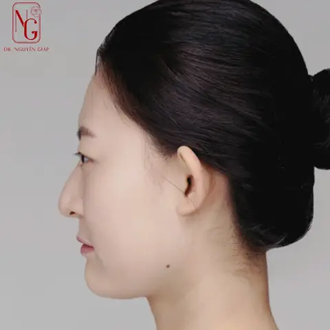 Trán Lõm Nhân Tướng Học