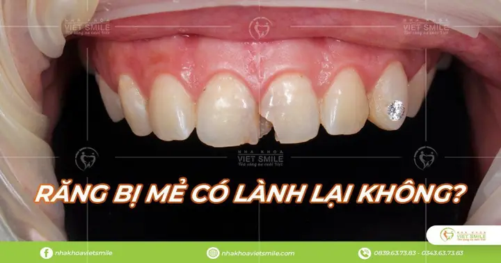 Tự Nhiên Bị Gãy Răng Có Điềm Gì Tự Nhiên Bị Gãy Răng Có Điềm Gì