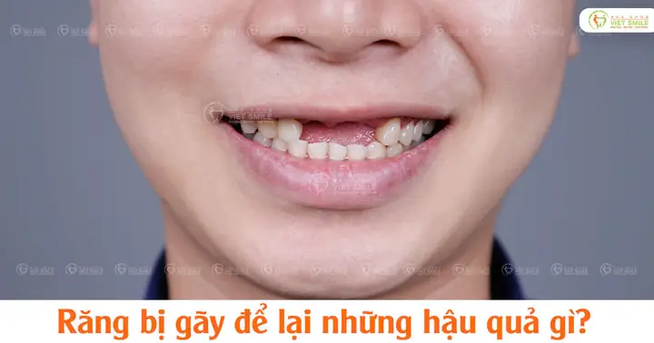 Tự Nhiên Bị Gãy Răng Có Điềm Gì Tự Nhiên Bị Gãy Răng Có Điềm Gì