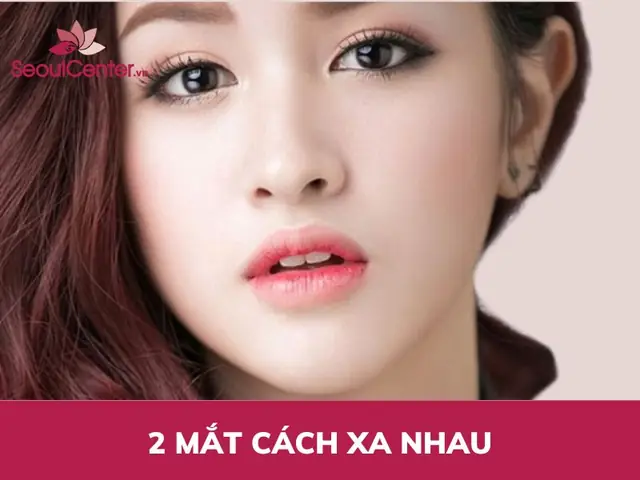 Tướng 2 Mắt Xa Nhau