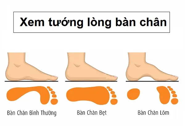 Tướng Bàn Chân Lõm Sâu