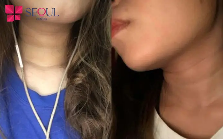 Tướng Bụng 3 Ngấn